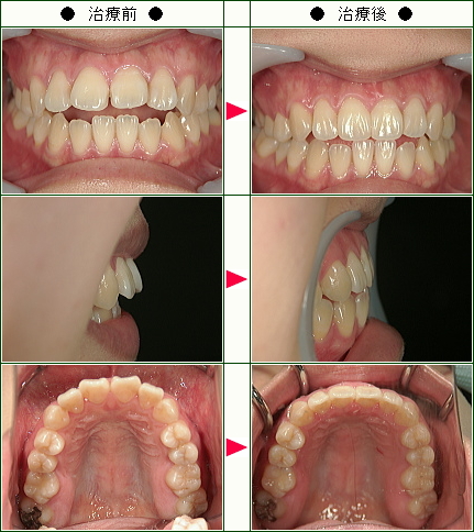 出っ歯矯正症例(ようこ様　２４歳　女性)