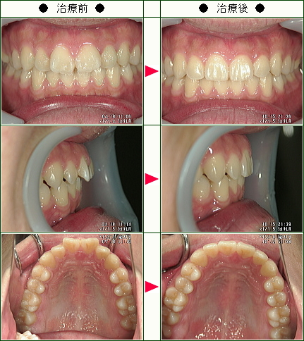 歯のデコボコ矯正症例(Ｙ・Ｓ様　２１歳　男性)