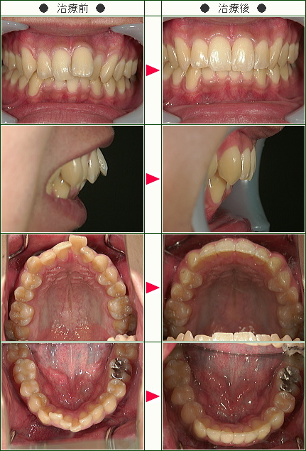 歯のデコボコ矯正症例(Ｙ．Ｓ様　２５歳　女性)