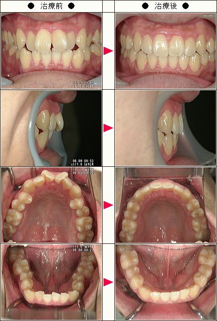 歯のデコボコ矯正症例［Ｙ.Ｓ様　２８歳　男性］