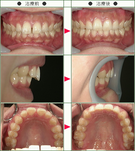 前歯のすきっ歯矯正症例(Ｙ.Ｓ様　３０歳　女性)