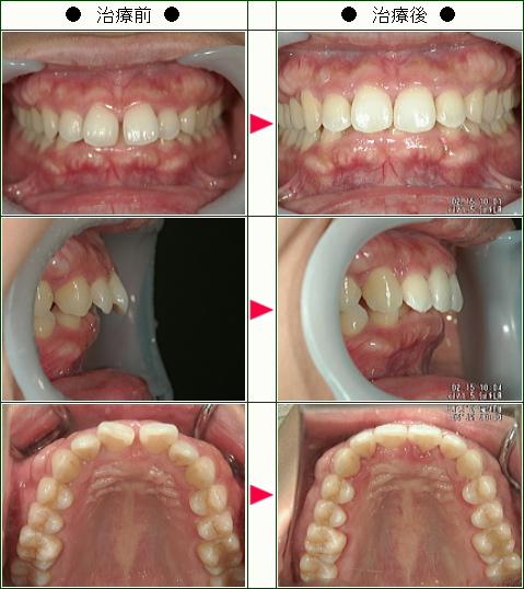 前歯のすきっ歯矯正症例(Ｙ.Ｓ様　３５歳　女性)