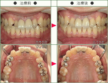 歯のデコボコ矯正症例(Ｙ・Ｓ様　３６歳　女性)