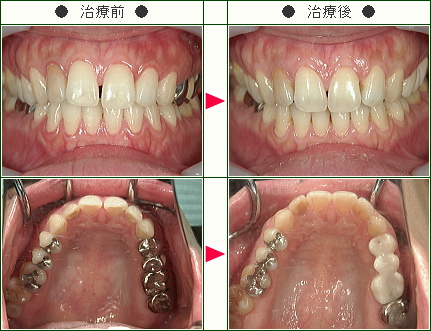 前歯のすきっ歯矯正症例(Ｙ．Ｓ歳　３９歳　女性)