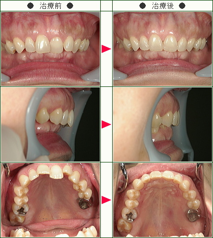 歯のデコボコ症例(Ｙ.Ｓ様　５４歳　女性)