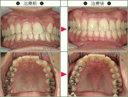 歯のデコボコ矯正症例(Ｙ．Ｔ様　３０歳　男性)