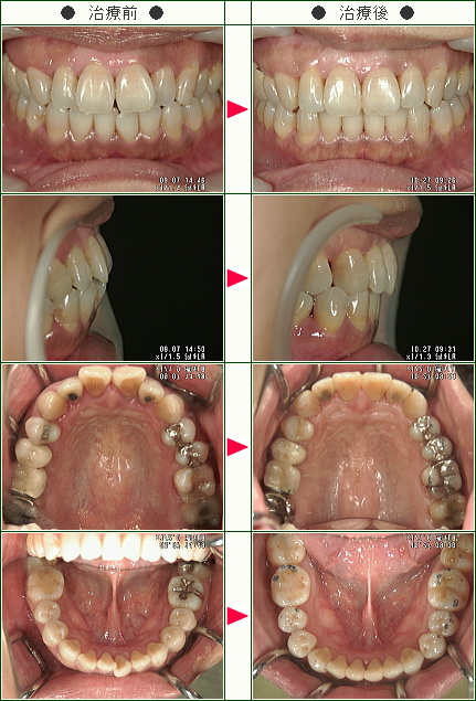 歯のデコボコ矯正症例(Ｙ・Ｔ様　３９歳　女性)