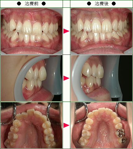 歯のデコボコ矯正症例(Ｙ・Ｕ様　２３歳　女性)