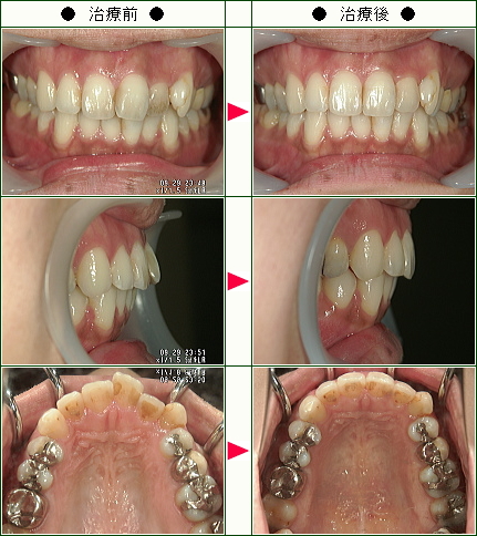 歯のデコボコ矯正症例(Ｙ.Ｕ様　２９歳　女性)