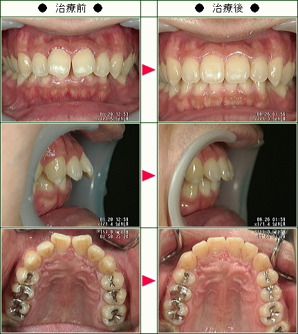 歯のデコボコ矯正症例(Ｙ．Ｕ様　３９歳　男性)
