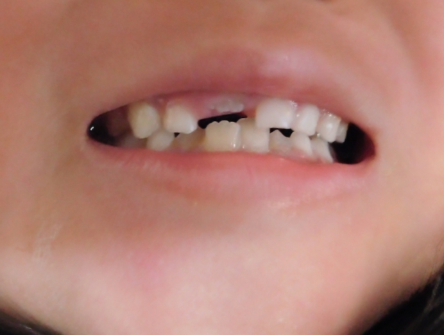癒合歯の特徴