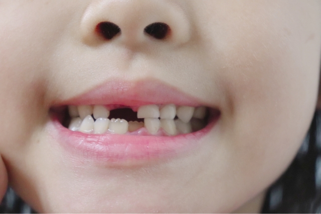 永久歯が3本以上生えず歯茎の切開術が必要