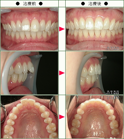出っ歯矯正症例(ゆき様　３２歳　女性)