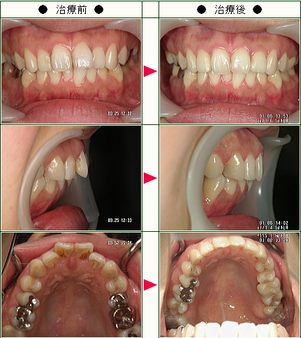 出っ歯矯正症例(幸恵様　２６歳　女性)