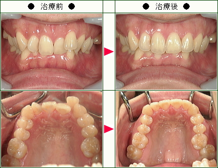 歯のデコボコ矯正症例(ゆきの様　２７歳　女性)