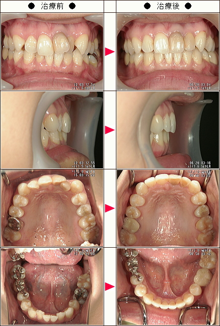 歯のデコボコ矯正症例［幸代様　３４歳　女性］