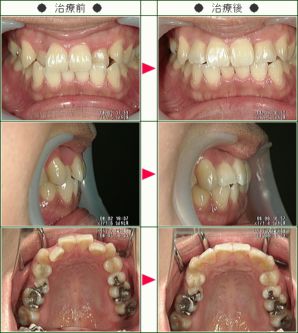 歯のデコボコ矯正症例(ゆこたん様　３１歳　女性)