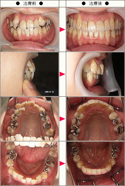 歯のデコボコ矯正症例［ゆみ様　２７歳　女性］