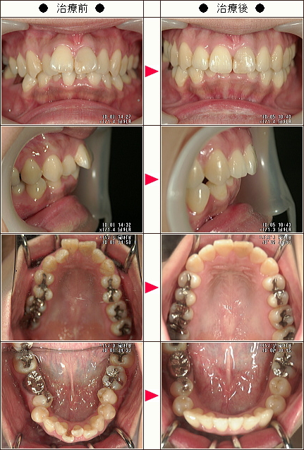 出っ歯矯正症例［弓夏様　３０歳　女性］
