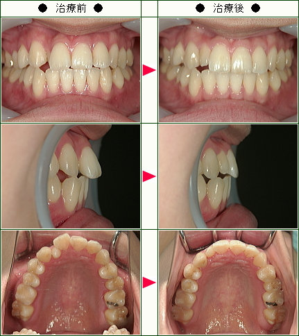 歯のデコボコ矯正症例(ゆみ子様　２４歳　女性)