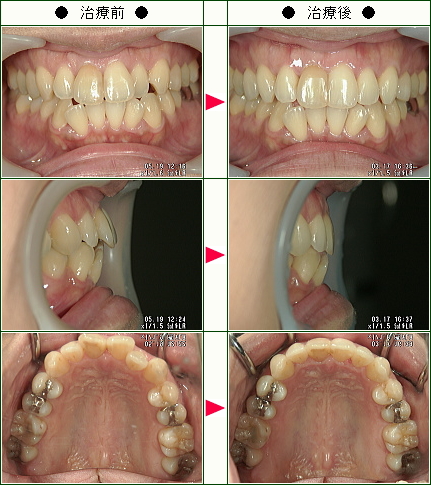 歯のデコボコ矯正症例(ユミコ様　３８歳　女性)