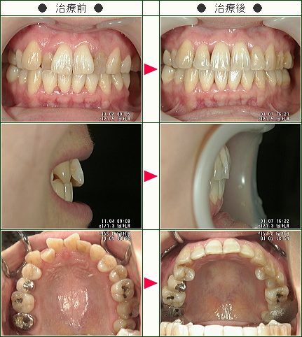 歯のデコボコ矯正症例(ユウタン様　３５歳　女性)
