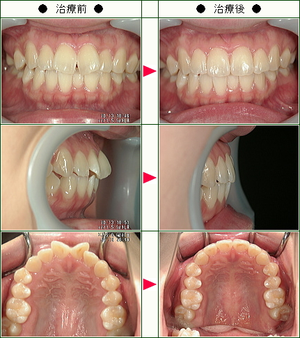 歯のデコボコ矯正症例(Ｙ.Ｙ様　２４歳　女性)