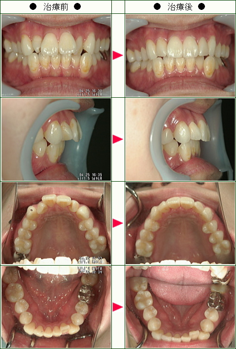 歯のデコボコ矯正症例(Ｙ・Ｙ様　３１歳　女性)