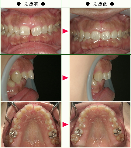 前歯のすきっ歯矯正症例(Ｙ.Ｙ様　３４歳　女性)