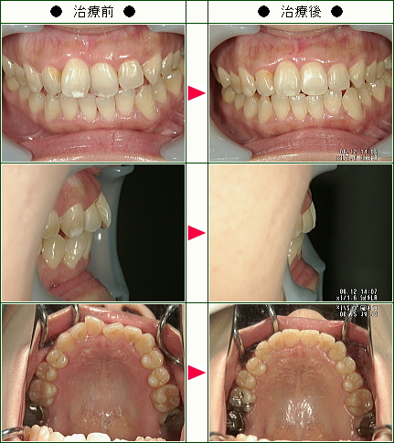 歯のデコボコ矯正症例(Ｙ.Ｙ様　３８歳　女性)